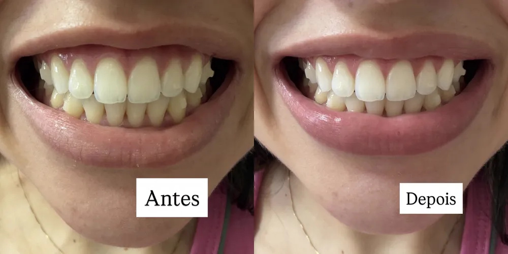 Antes e depois de cliente usando a pasta roxa